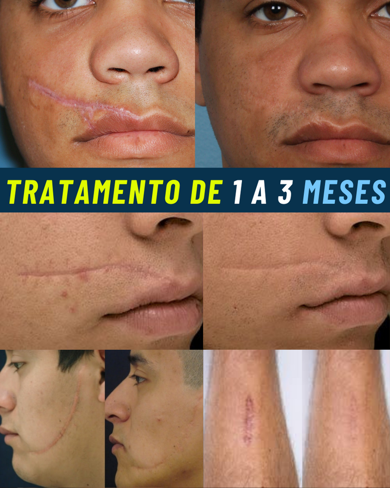 ScarRemove Cicatrizante Médico Avançado - Elimine Queloides e Cicatrizes Grossas